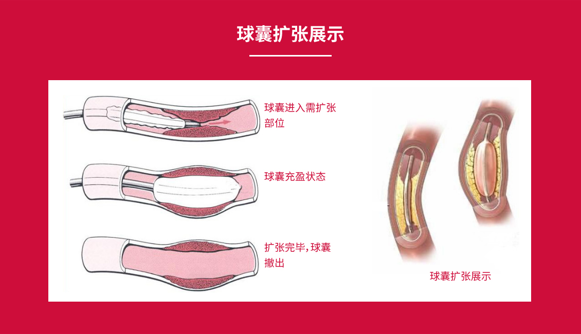球囊擴張導(dǎo)管_10.jpg